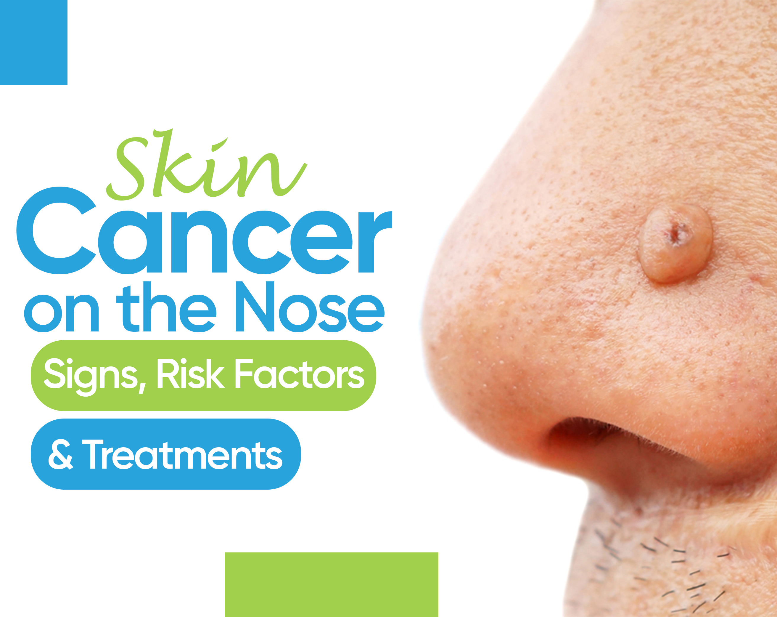 Skin Cancer on the Nose: Signs, Risk Factors & Treatments