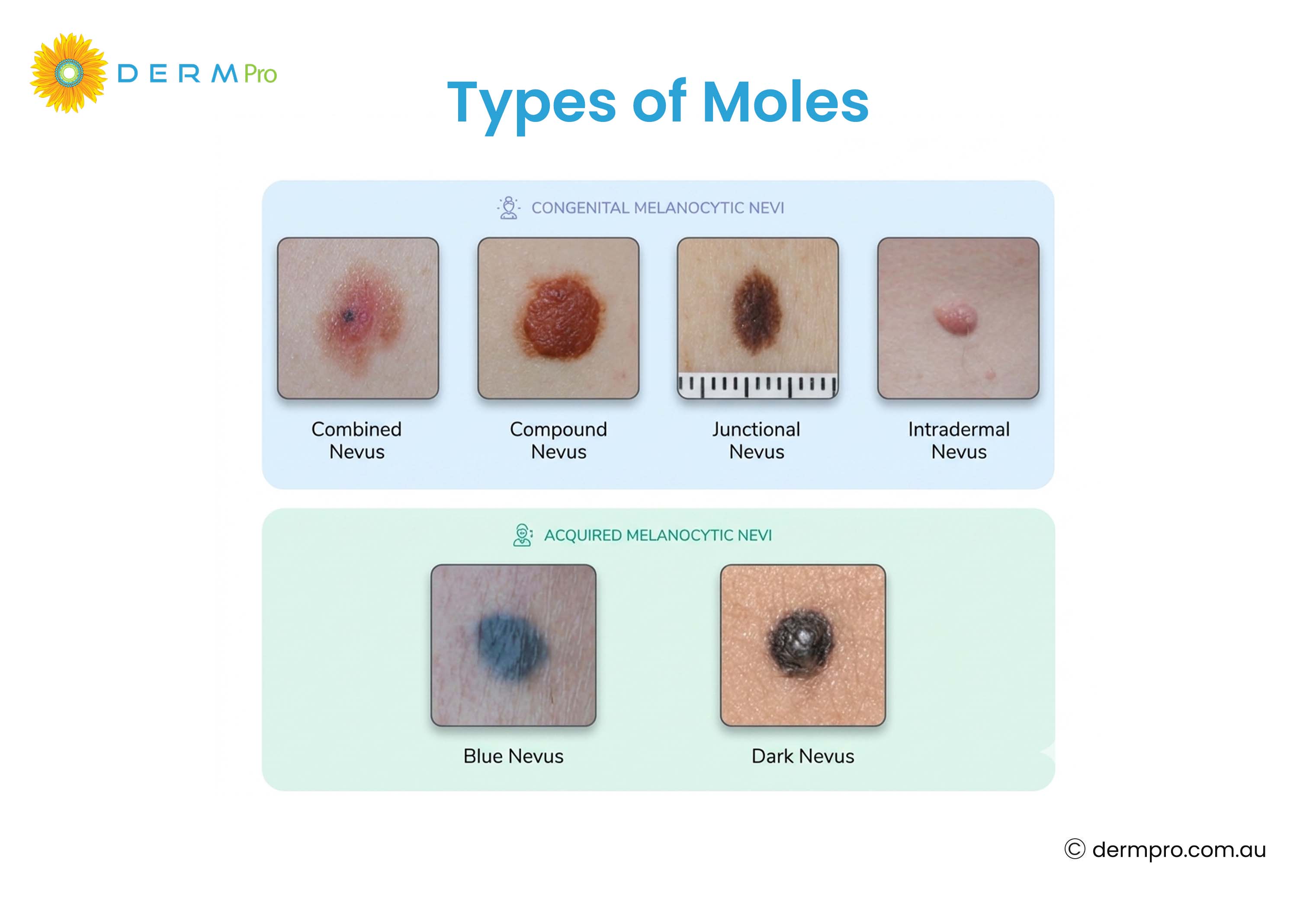 Types of Moles 
