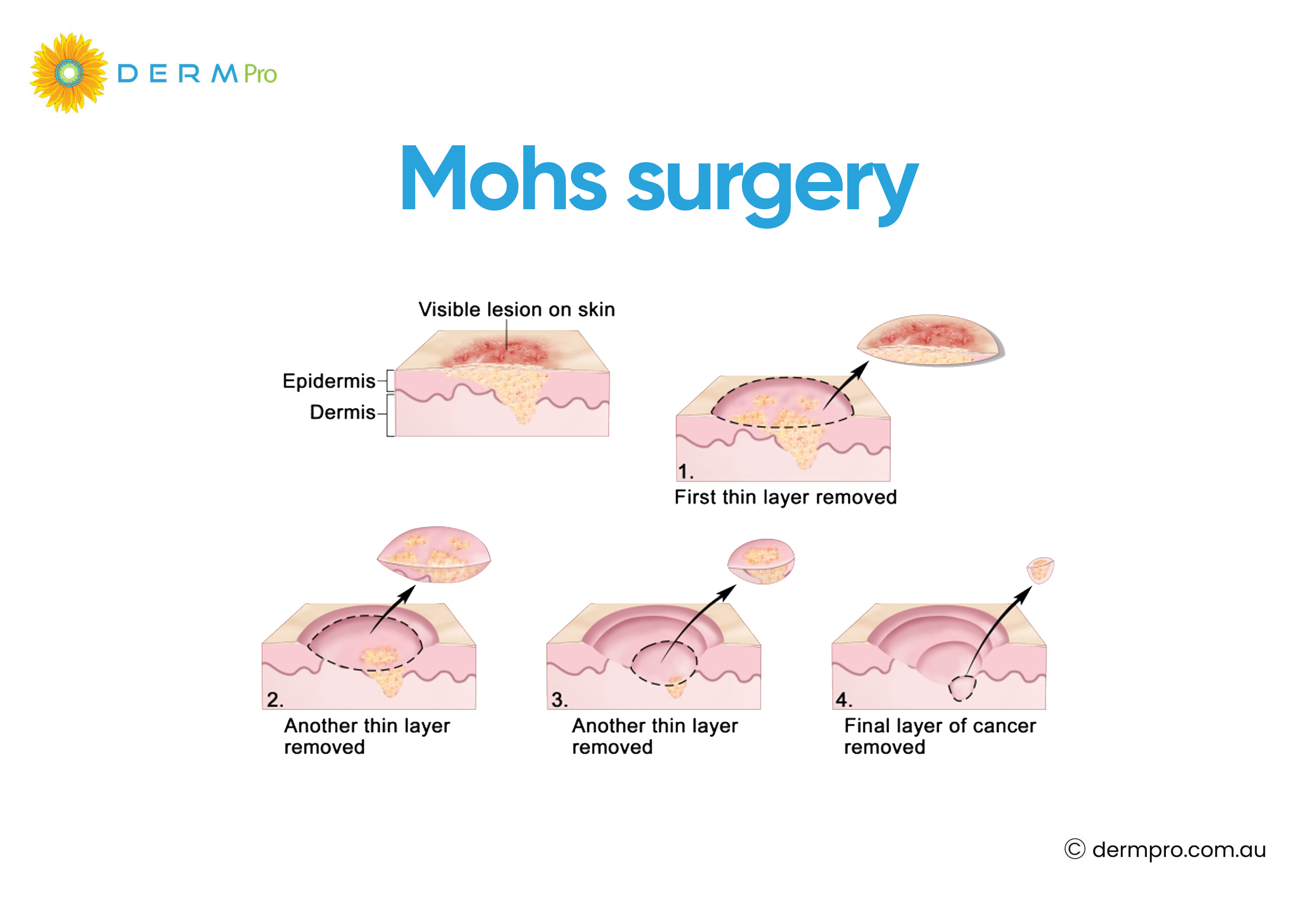 Mohs Surgery