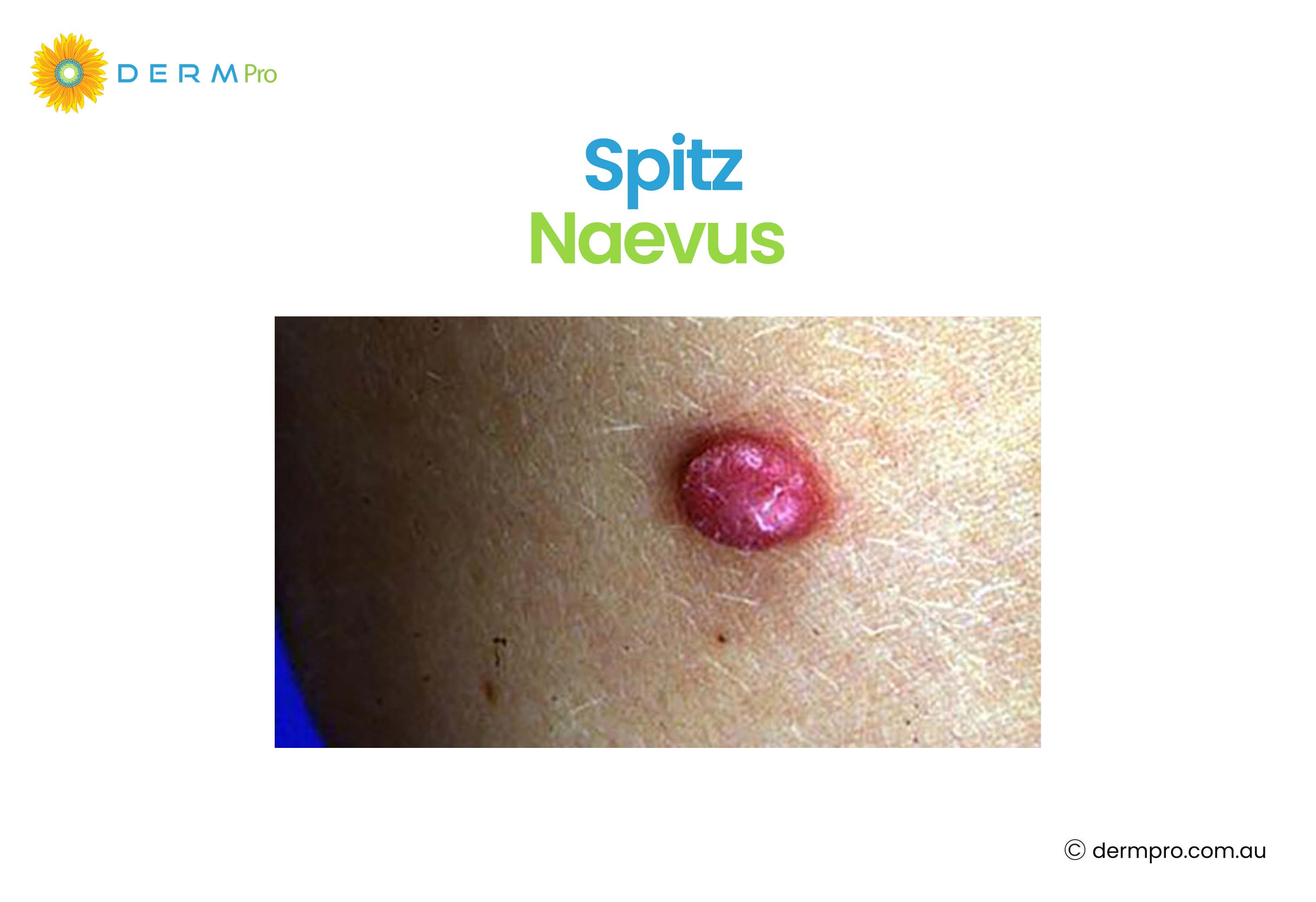 Spitz Naevus 