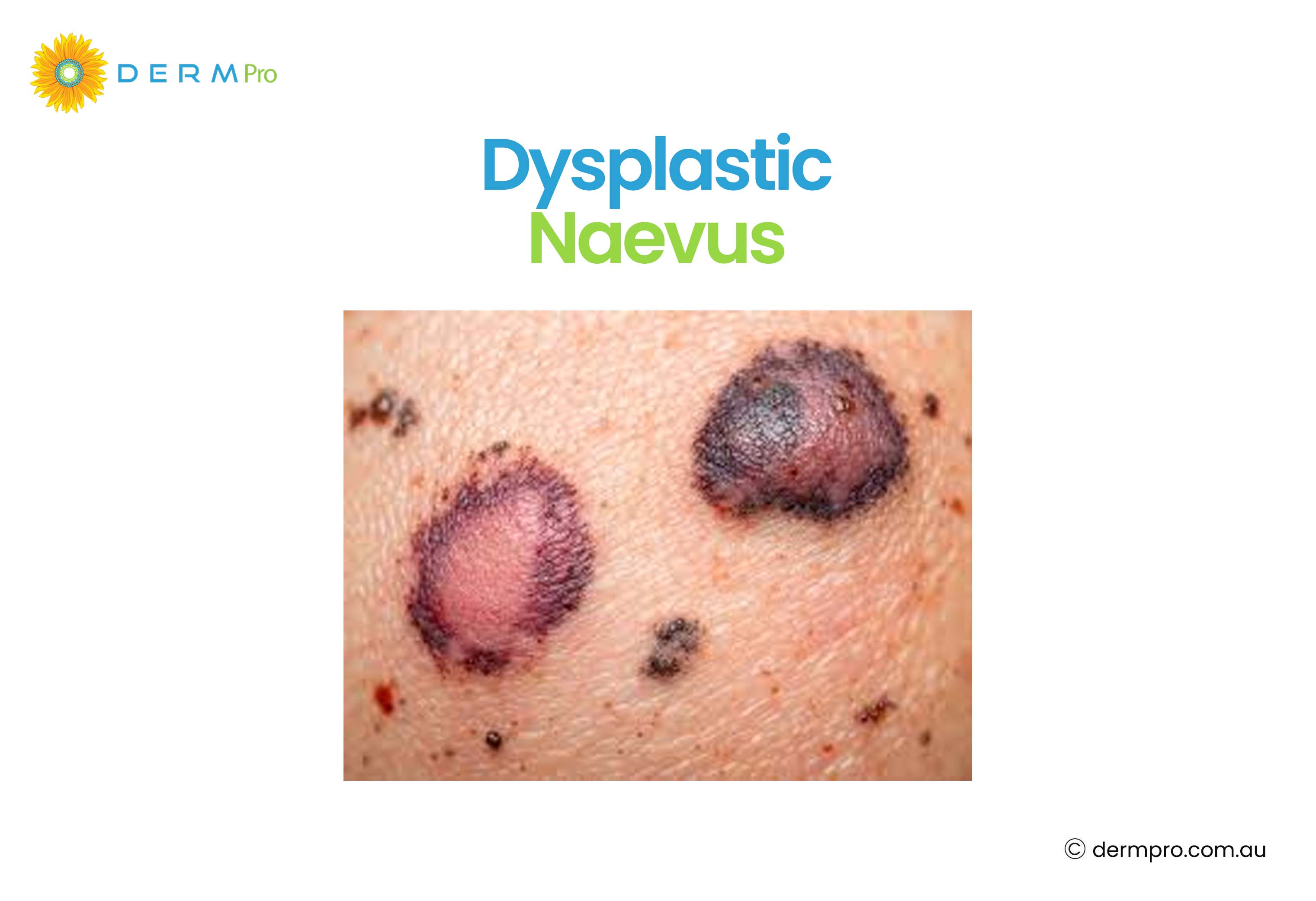 Dysplastic Naevus 