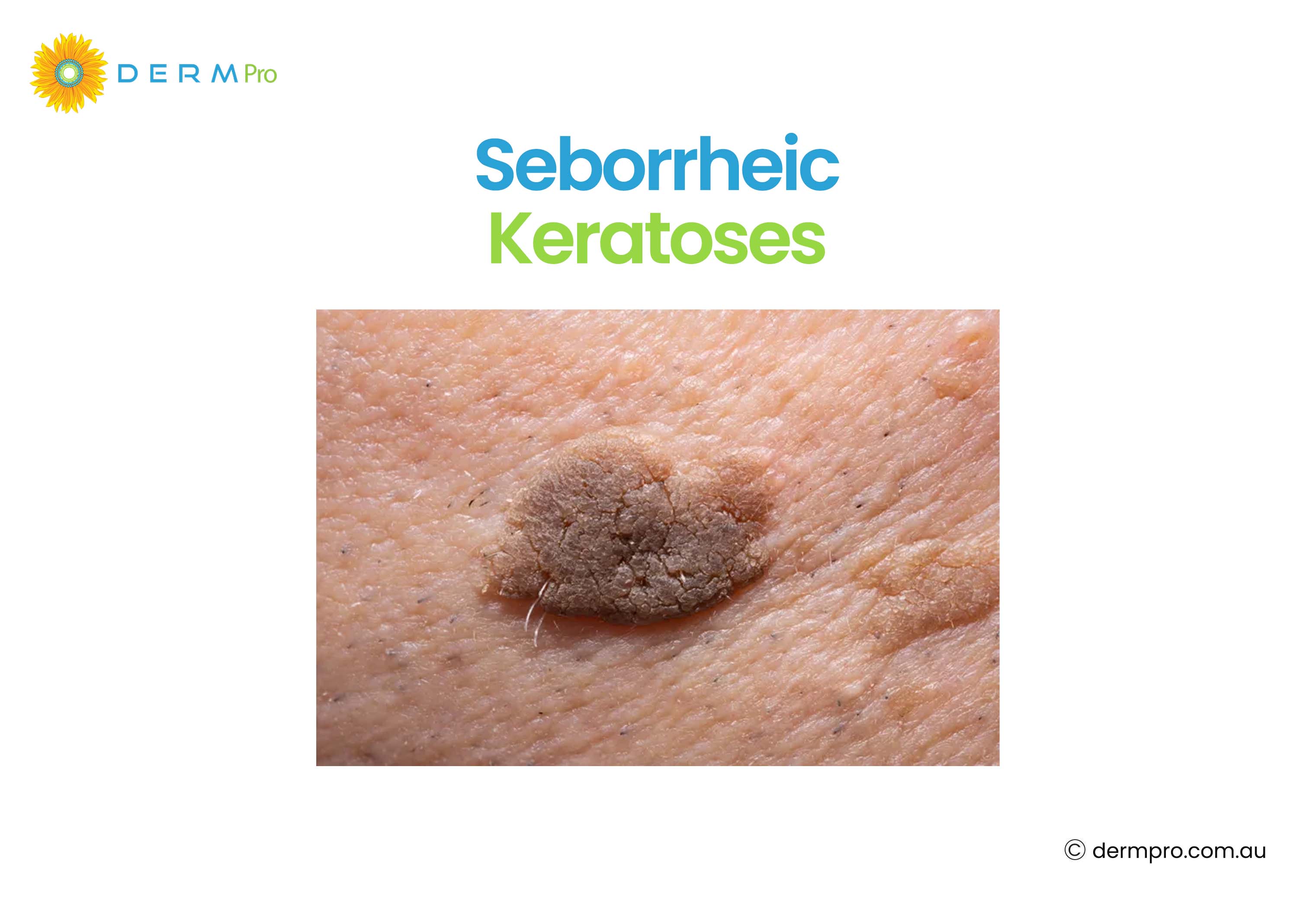Seborrheic Keratoses 