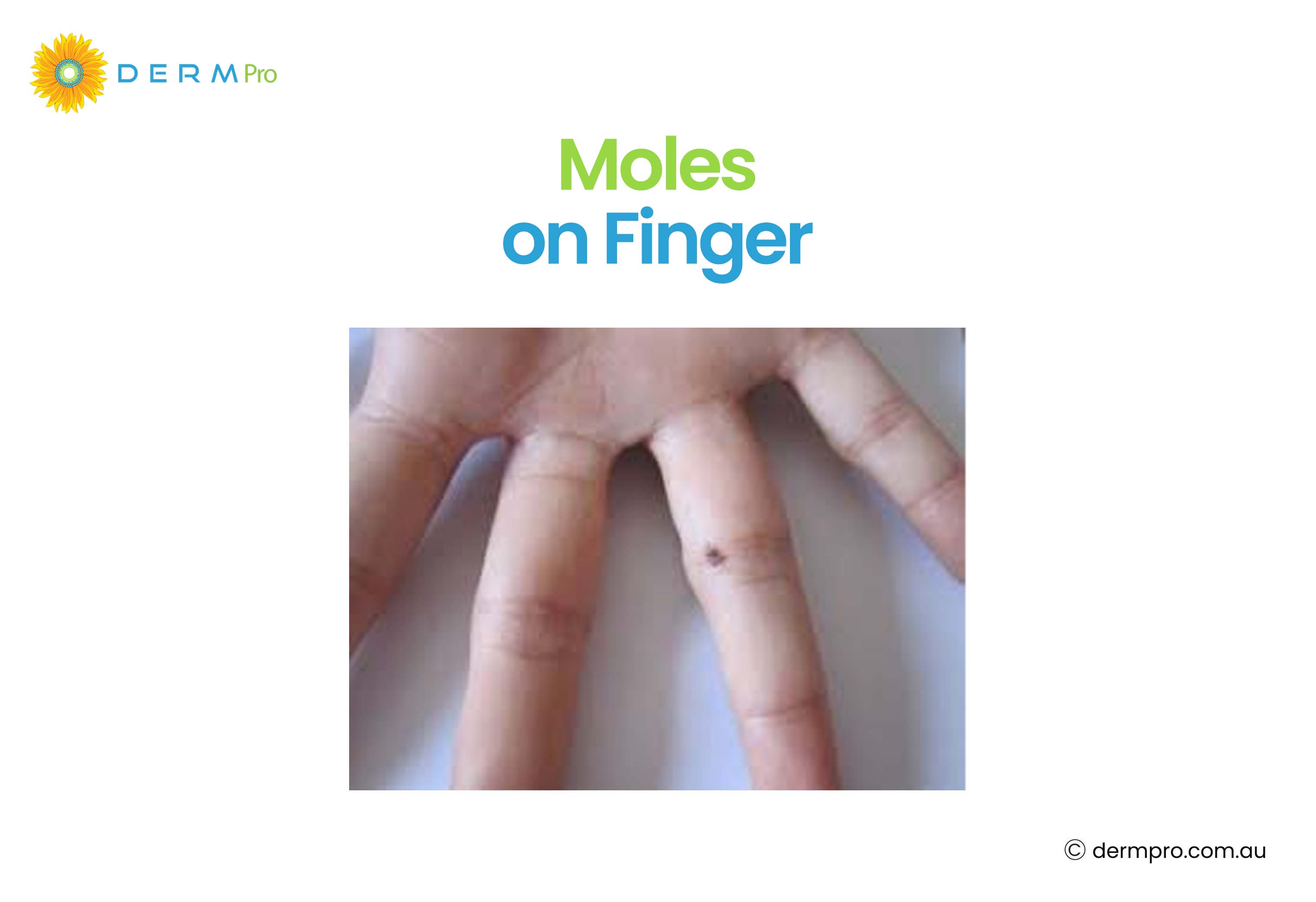 Moles on Finger 