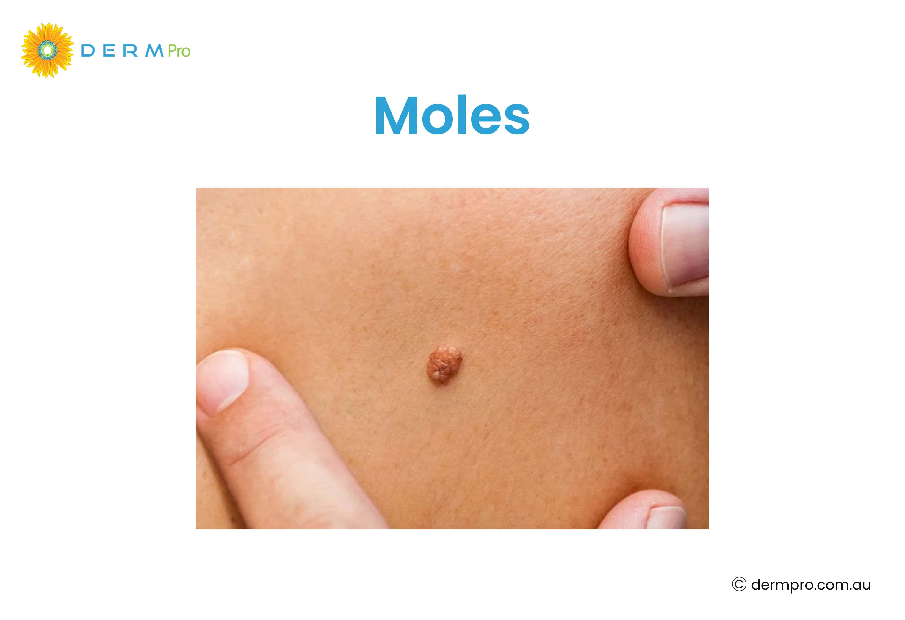 Moles 
