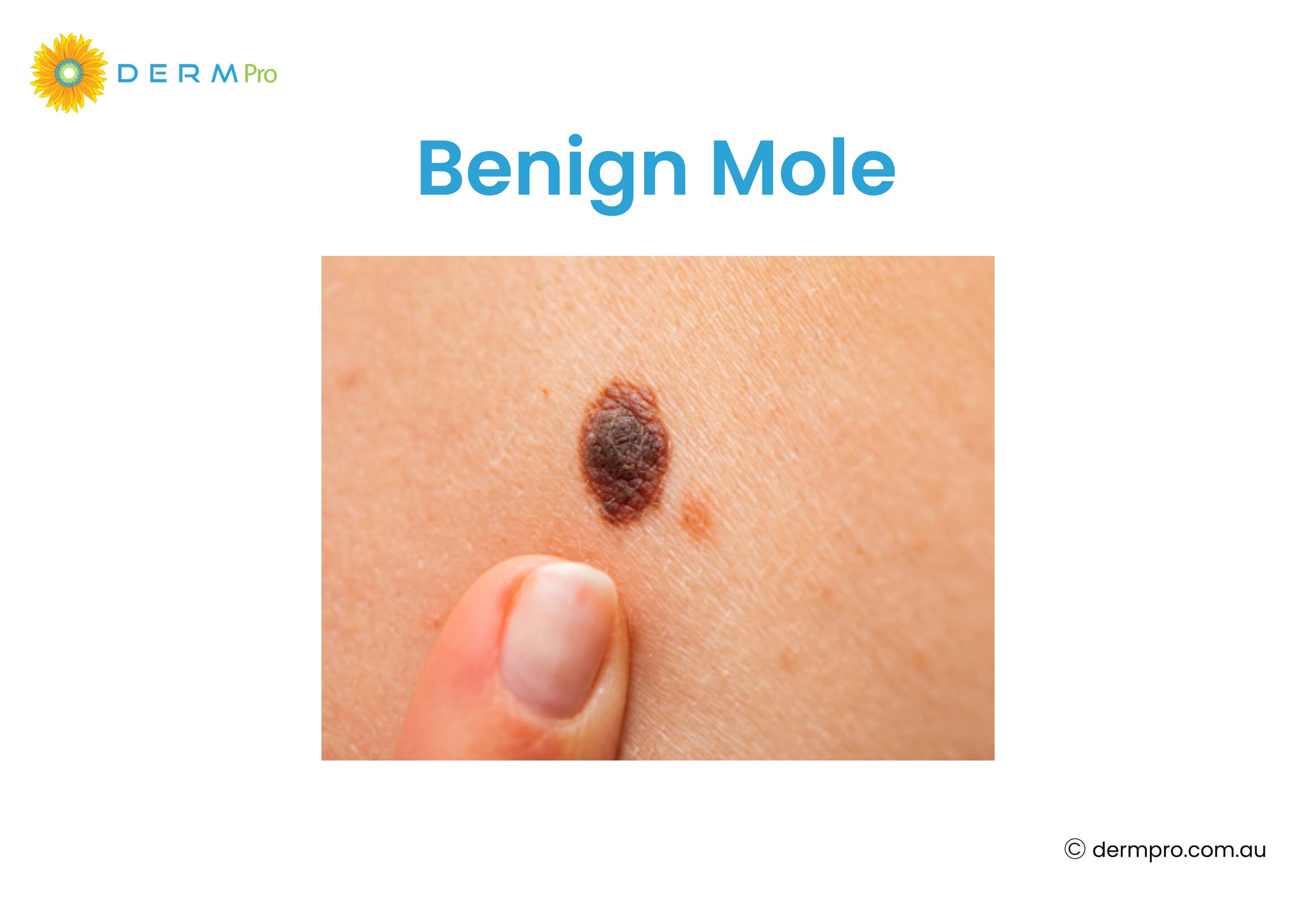 Benign Mole 