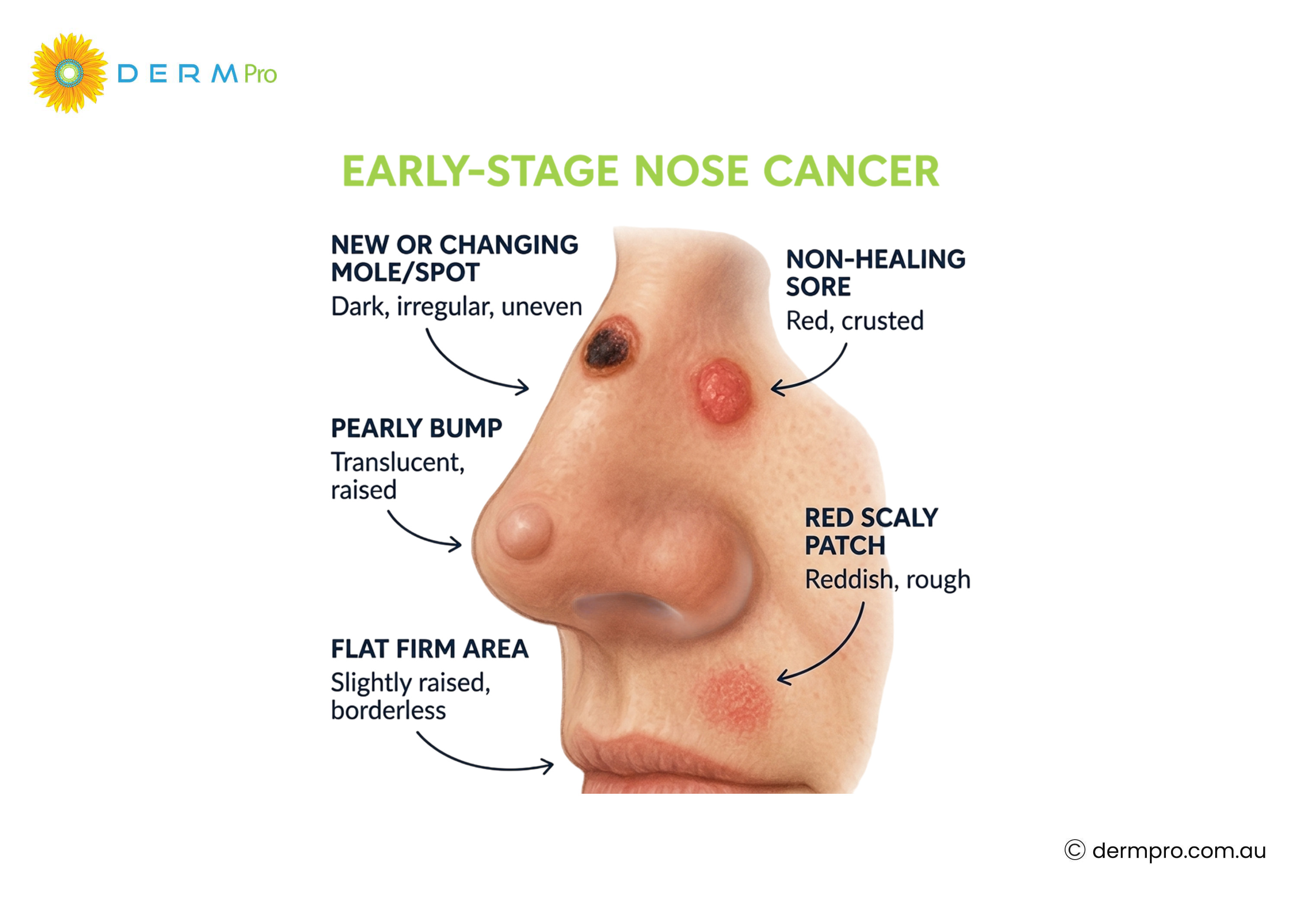 early stage nose cancer