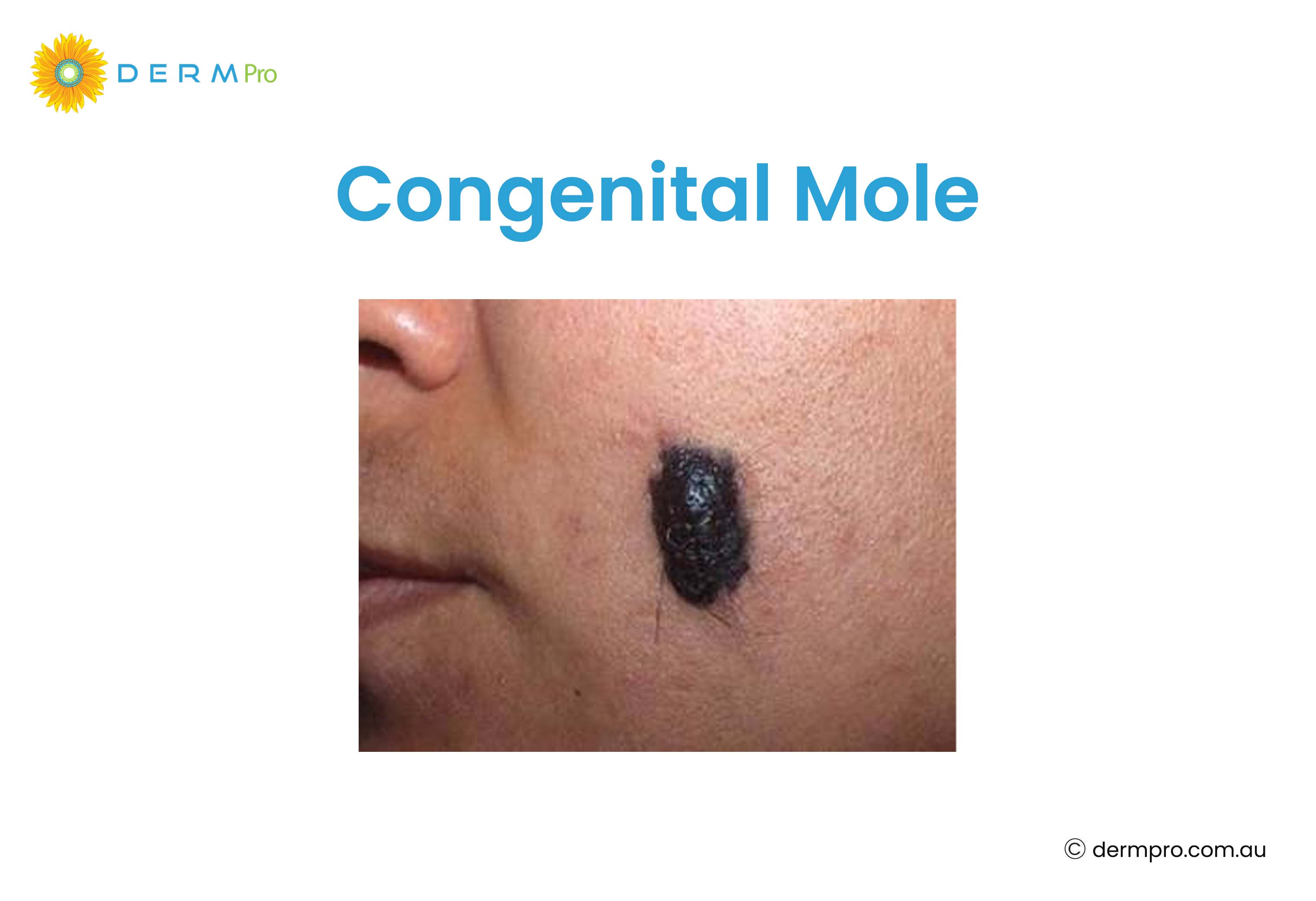 Congenital Mole 