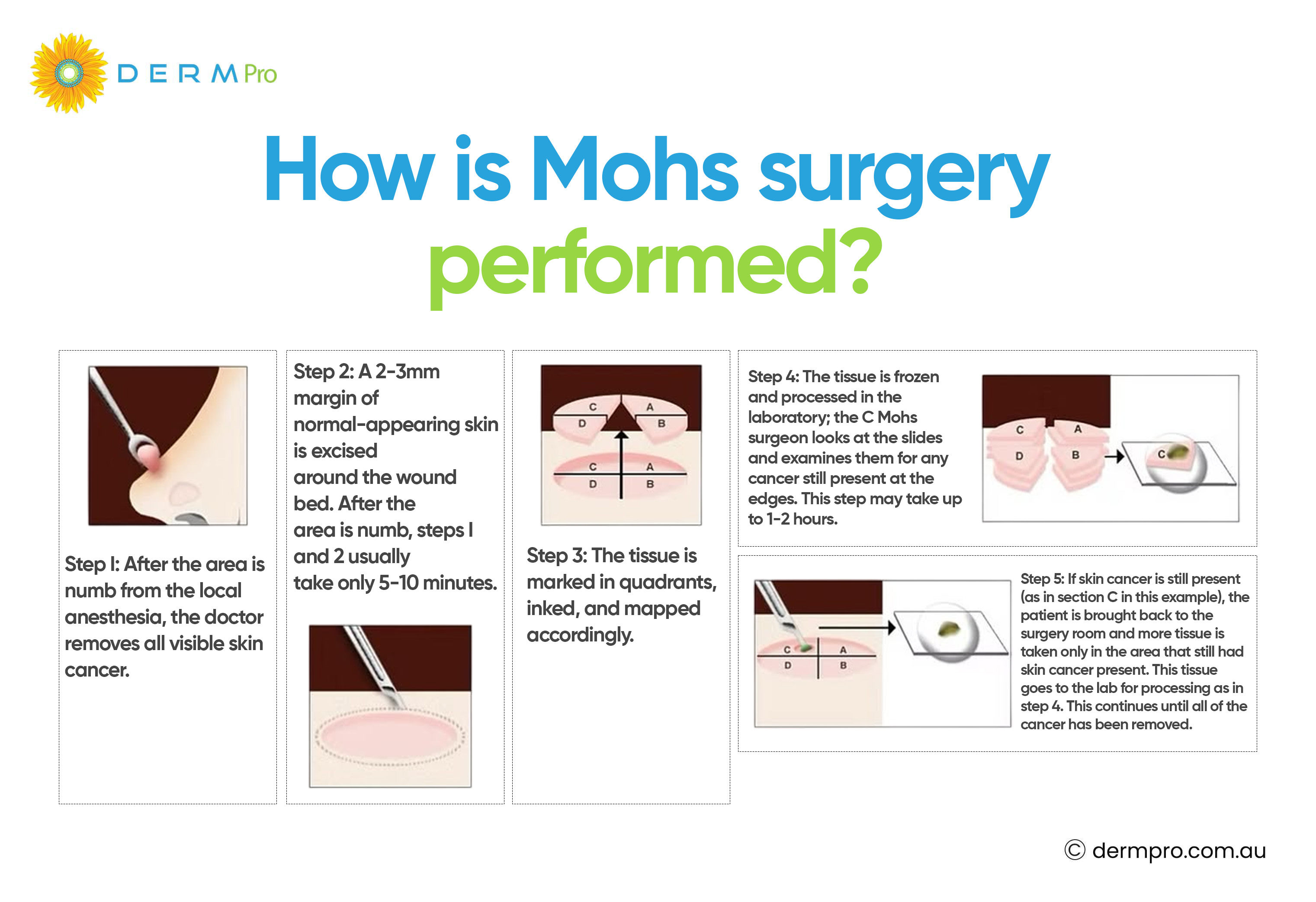 How is Mohs Surgery Performed?