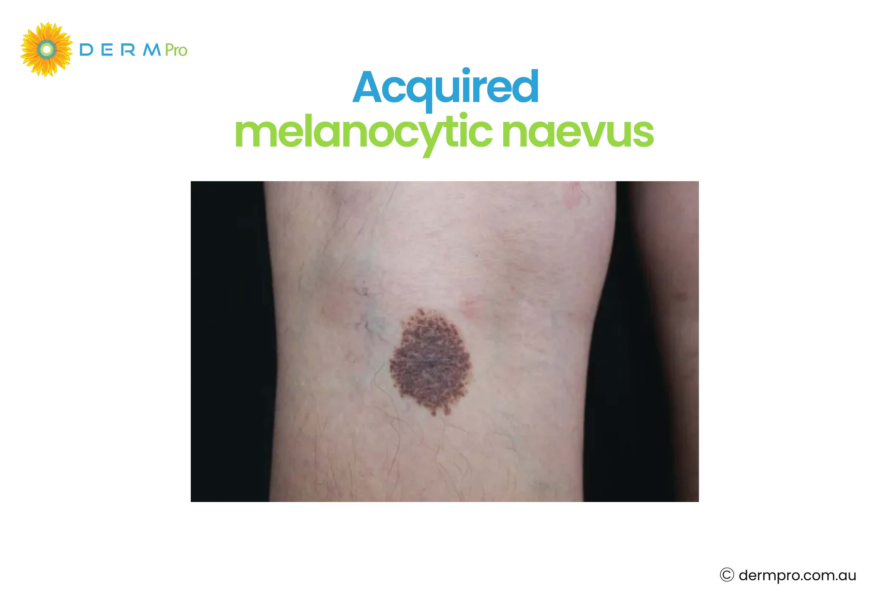 Accquired Melanocytic Naevus 