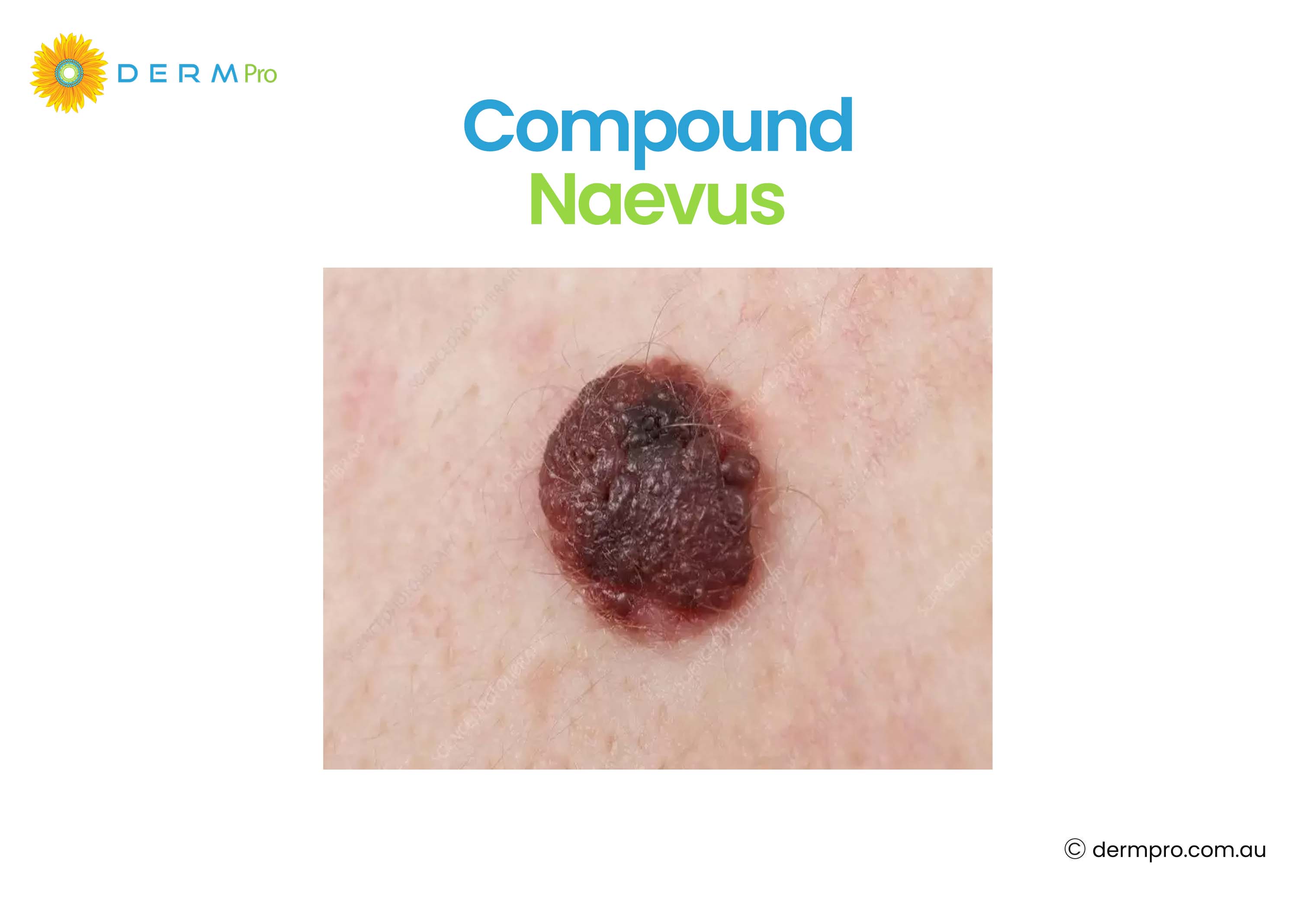 Compund Naevus 