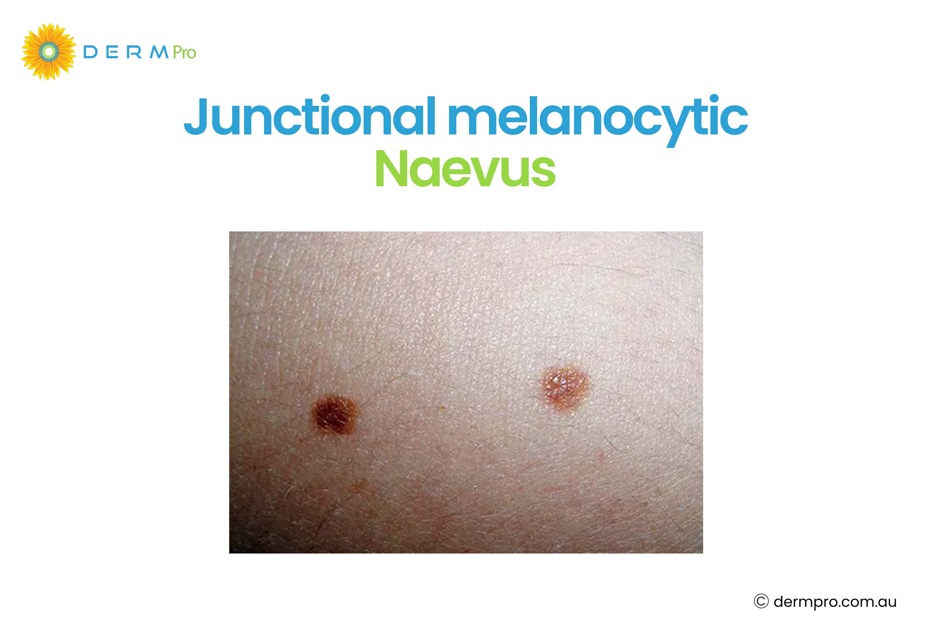 Junctional Melanocytic 