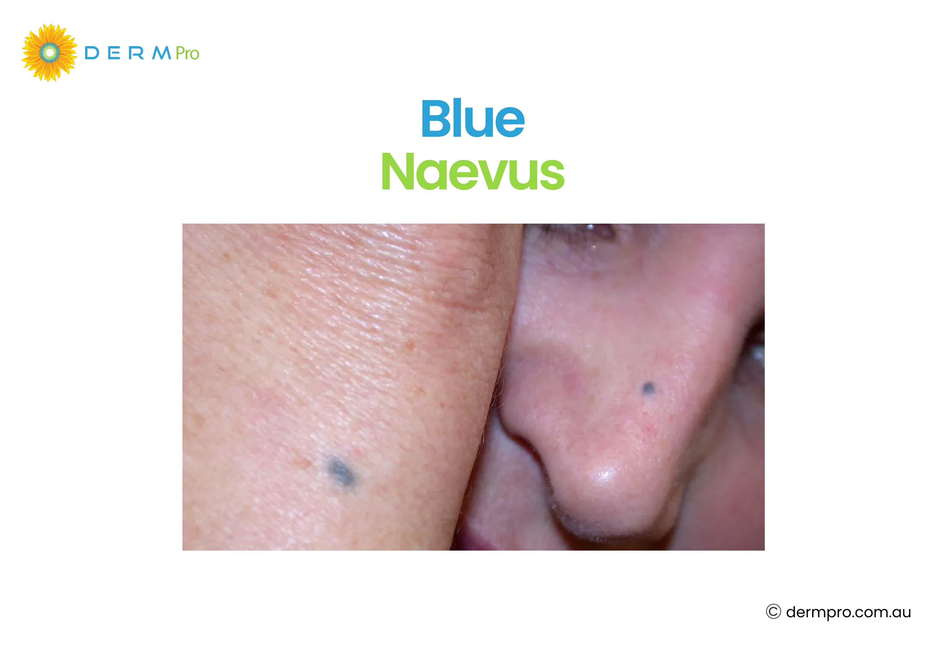Blue Naevus