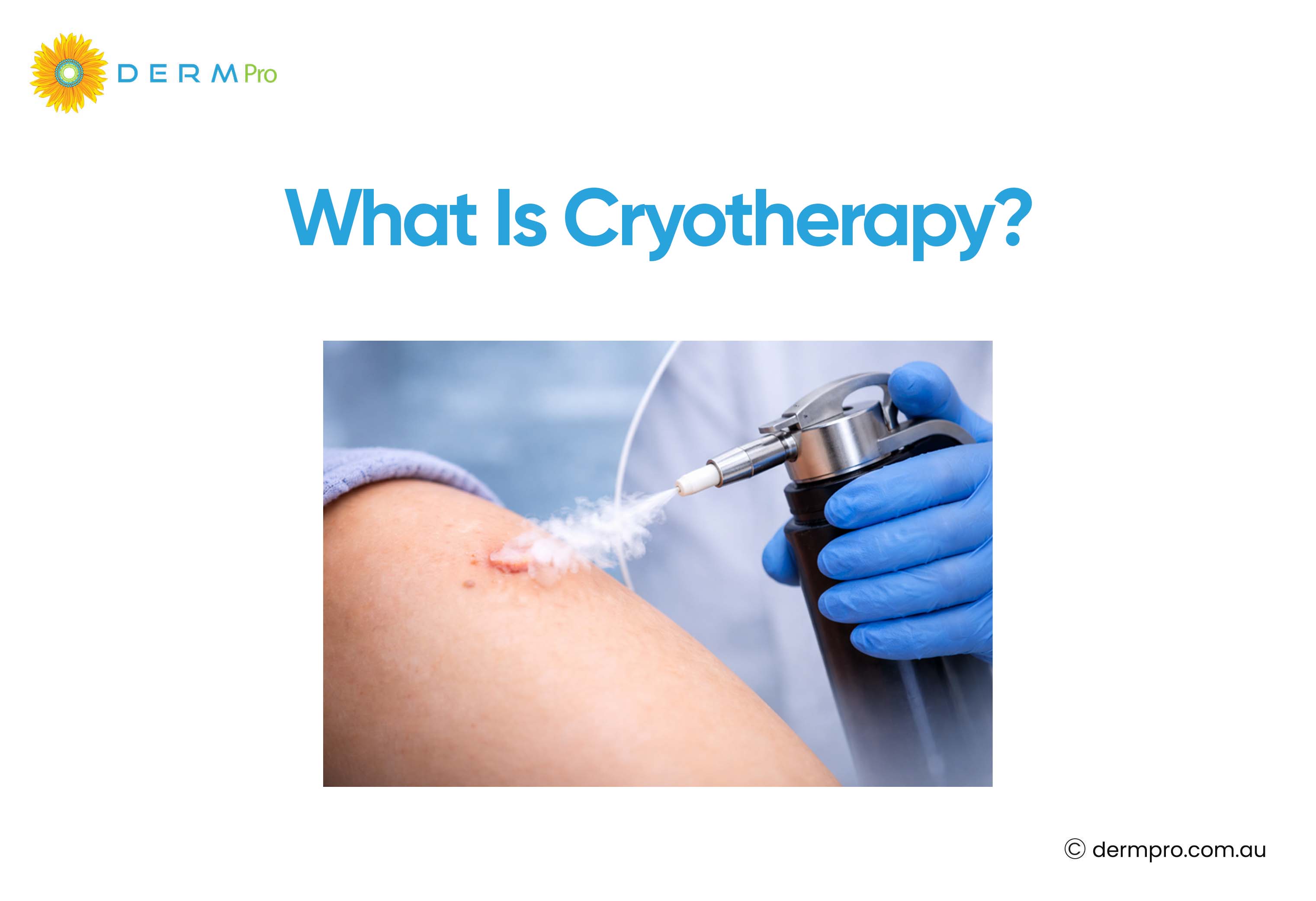 what is cryotherapy?