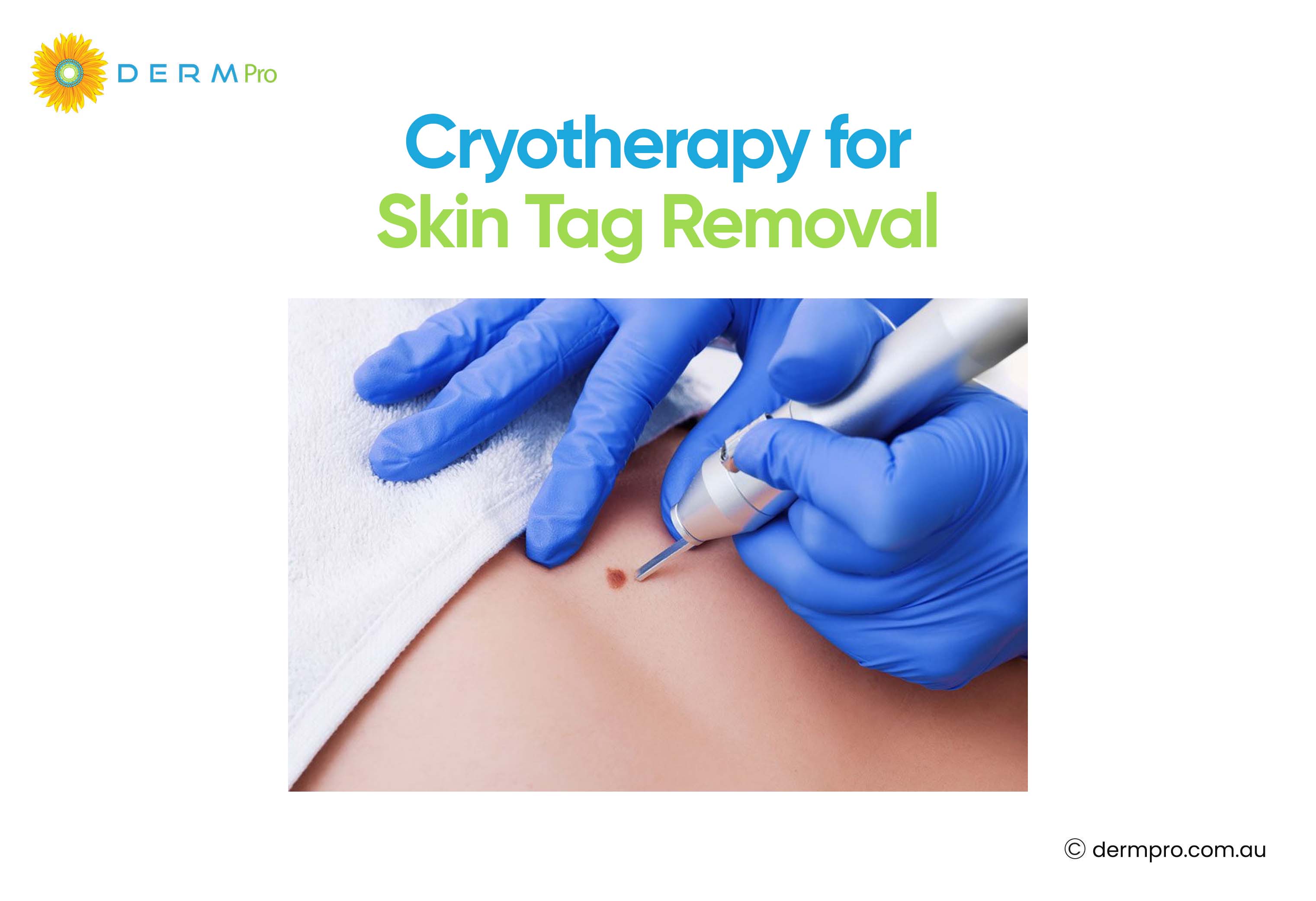 cryotherapy for skin tag removal