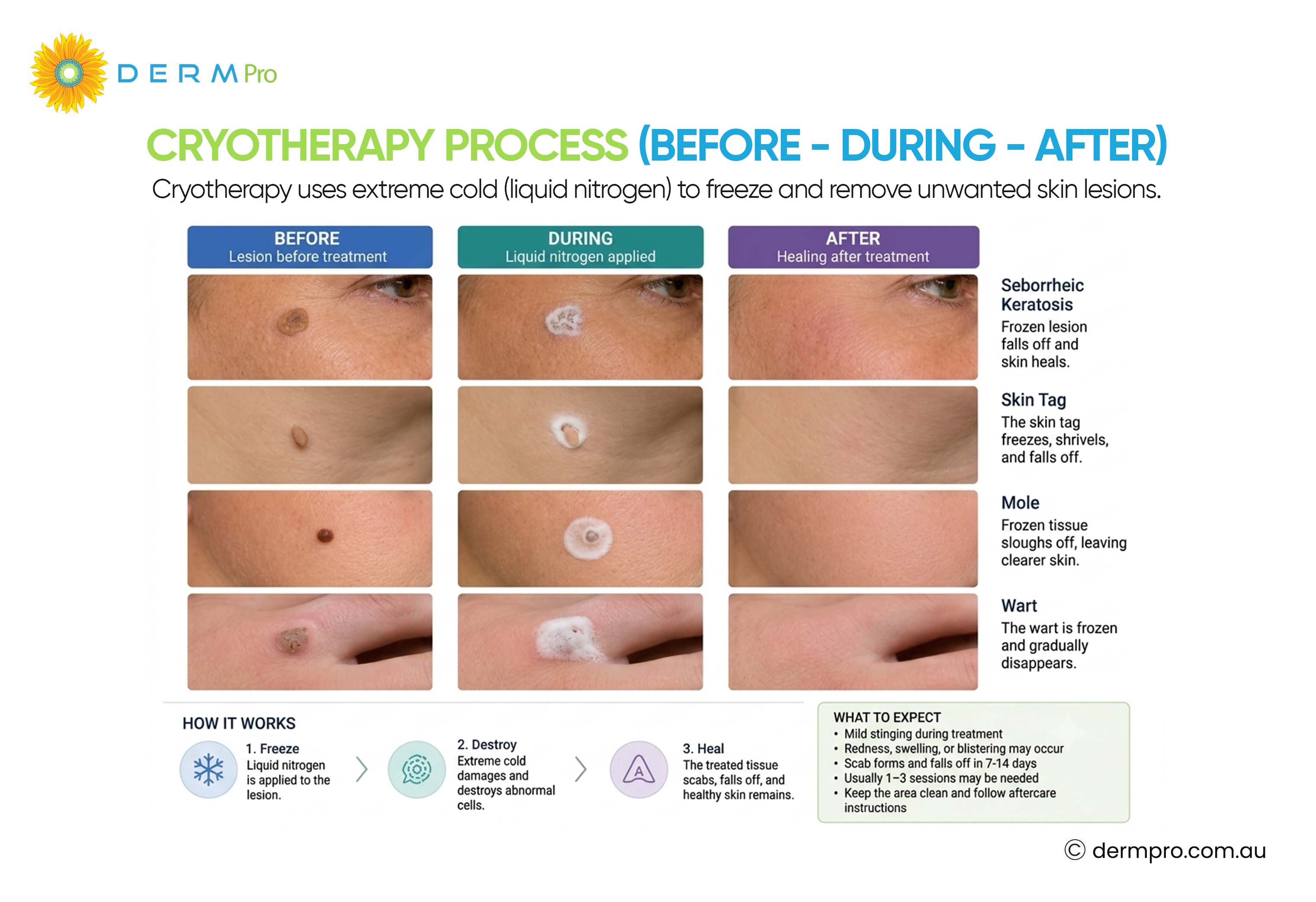 cryotherapy before and after process 