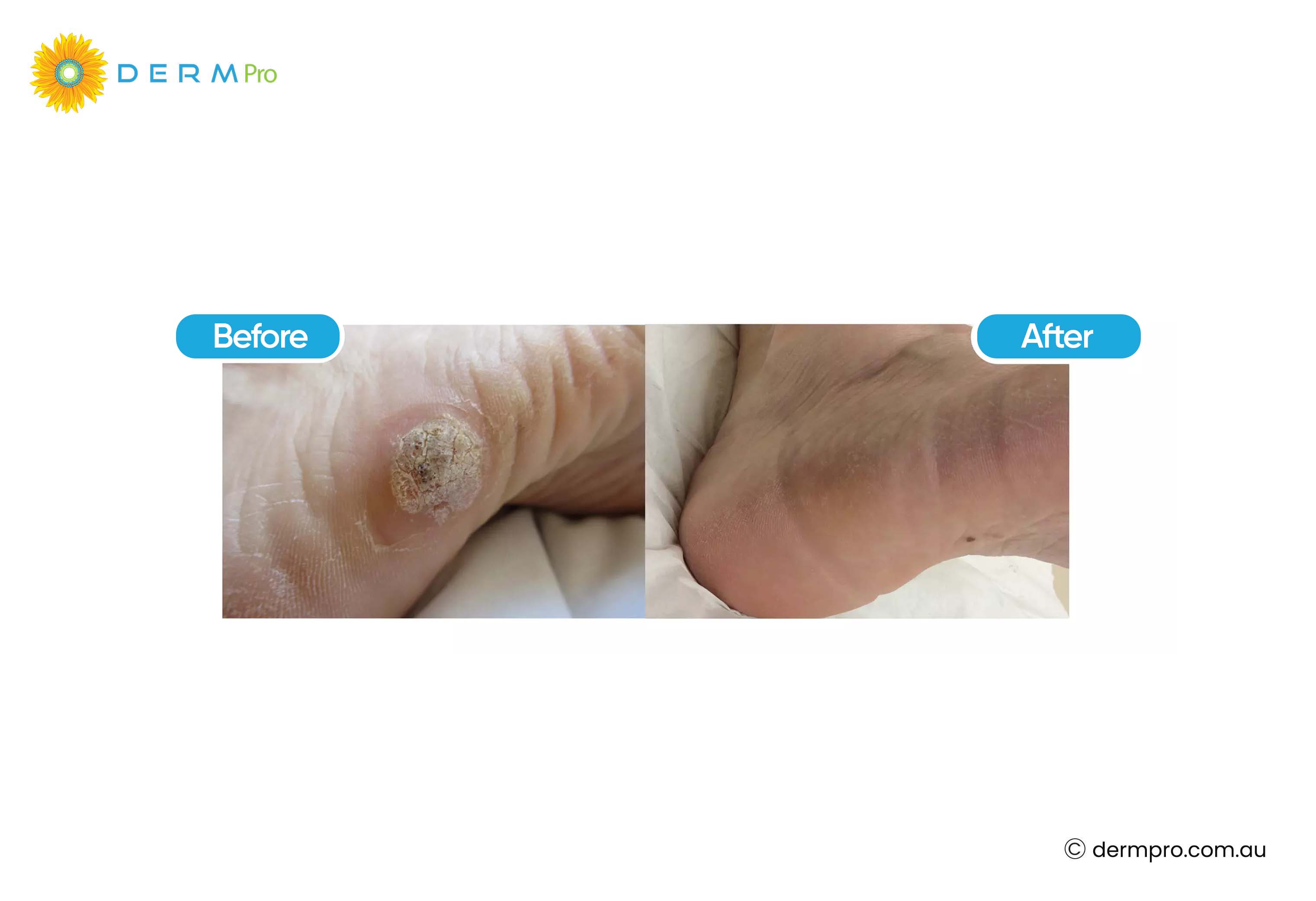 cryotherapy: before and after 