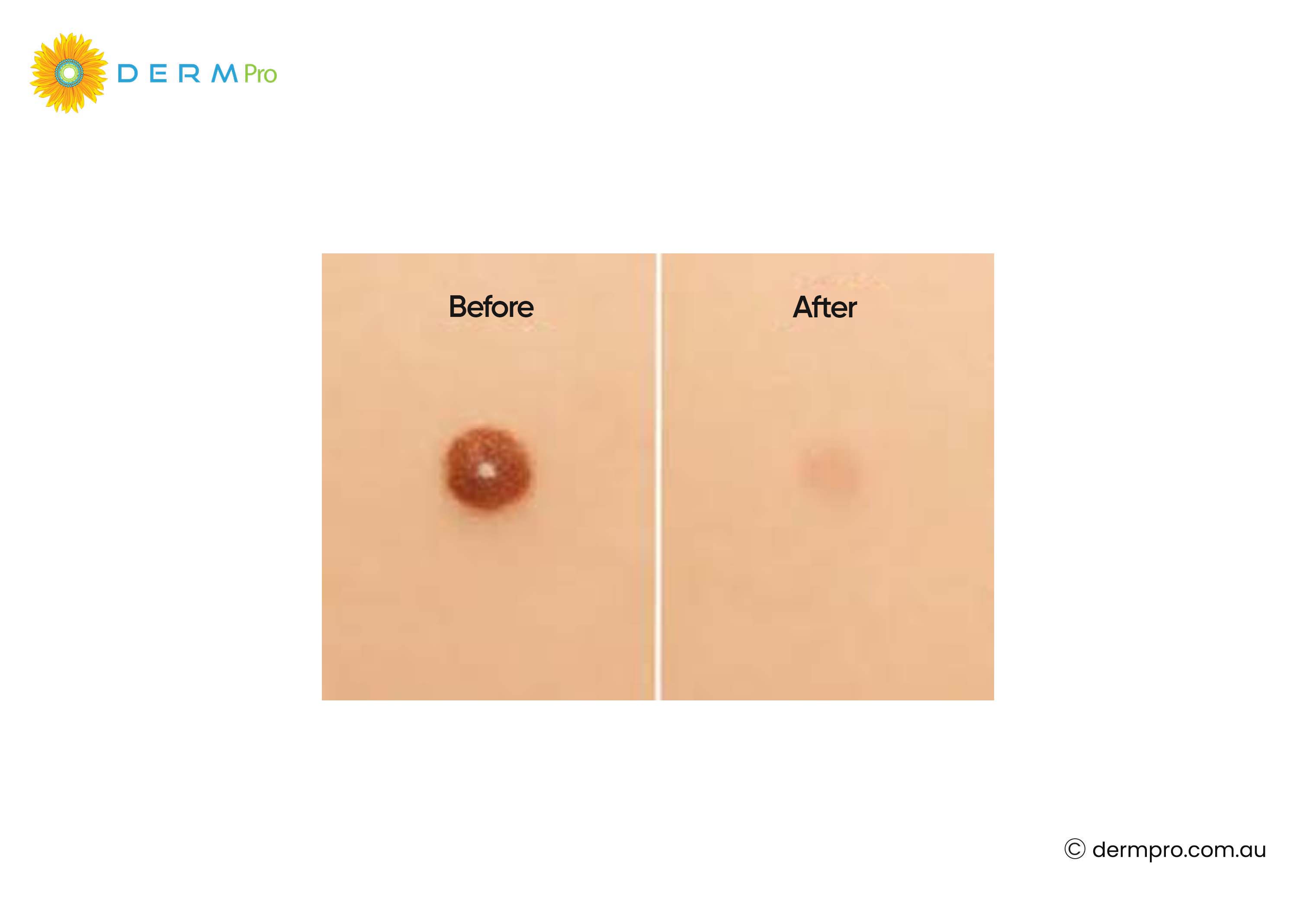 cryotherapy: before and after 